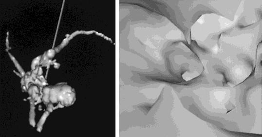 Nakagohri et al.: Virtual Pancreatoscopy 267 Fig. 6. Cystic lesion next to the pancreatic duct generated together with the pancreatic duct.