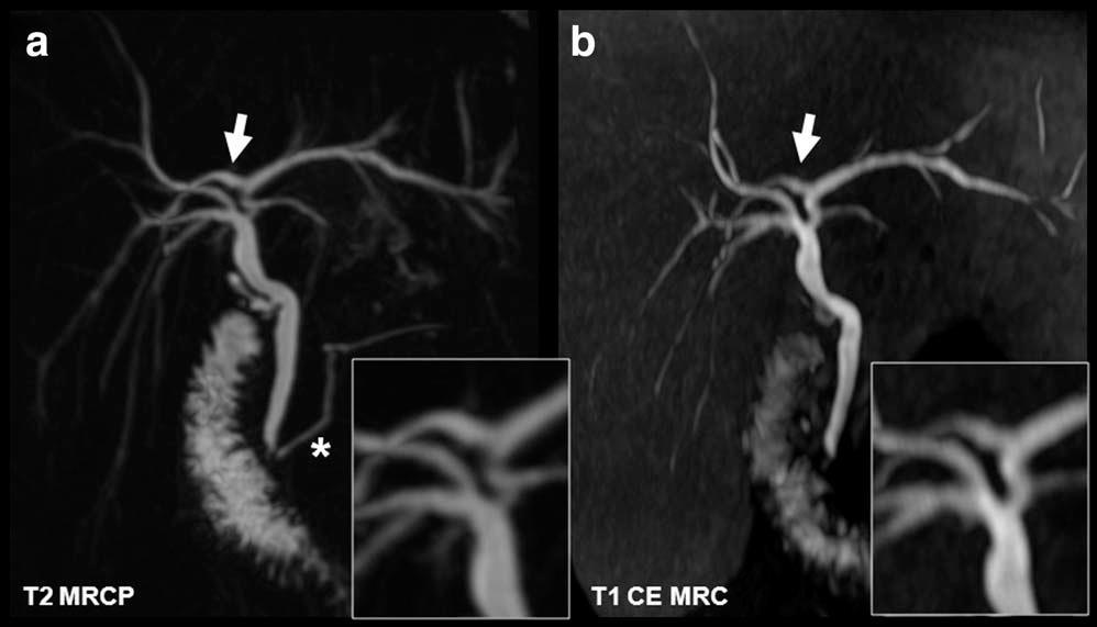 MR Cholangiography: Gadoxetic Acid Heavily T 2