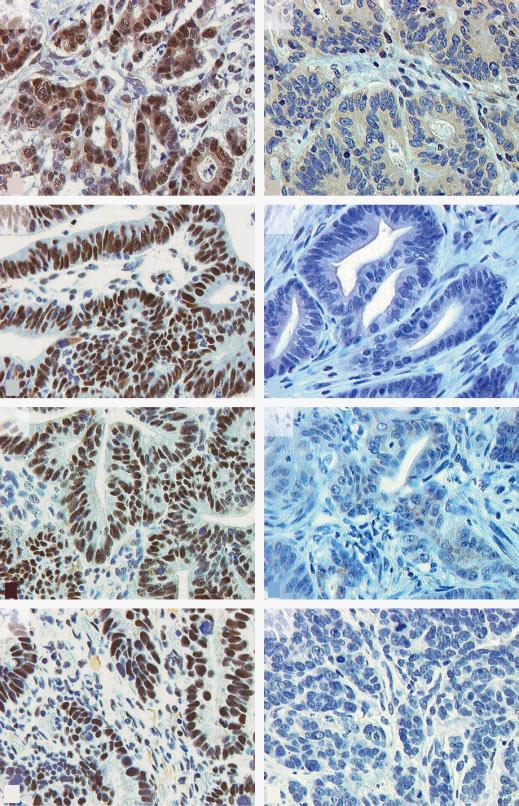 The new england journal of medicine A C E G Figure 3. Immunohistochemical Staining for Mismatch-Repair Proteins in Colorectal Adenocarcinoma.