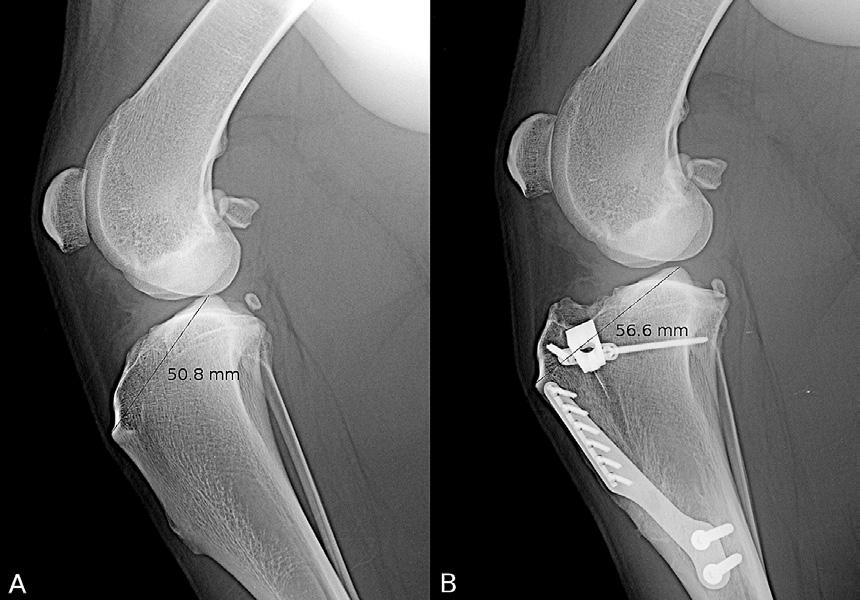 advancement surgery with three predetermined points of measurement on the patellar ligament. Fig. 2.