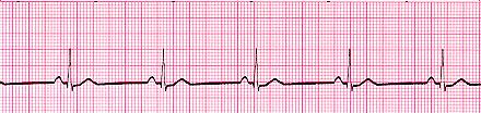 The technique is user-friendly, low cost and hence anyone skeptic of heart problem can analyze his/her ECG using this efficient method.