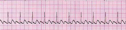 The heart rate of a person exceeds 100 BPM which results in an abnormality known as Sinus bradycardia highlighted in Fig.4.