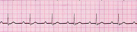 But if Shock is not the case then medication is the best way to suppress this abormal rhythm. Artrialflutter Atrial flutter (AFL) which is an abnormal heart rhythm depicted in Fig.