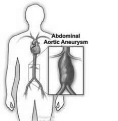 This leaflet tells you about small abdominal aortic aneurysms. What is the aorta? The aorta is the largest artery (blood vessel) in the body.