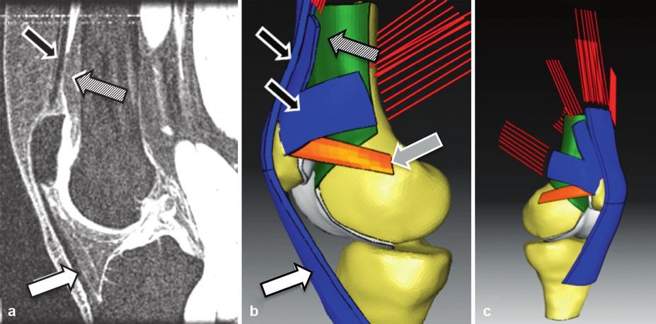 278 T.F. Besier et al. Fig..11 Sagittal MR image (a) and corresponding finite element model (b, c) of the patellofemoral joint.