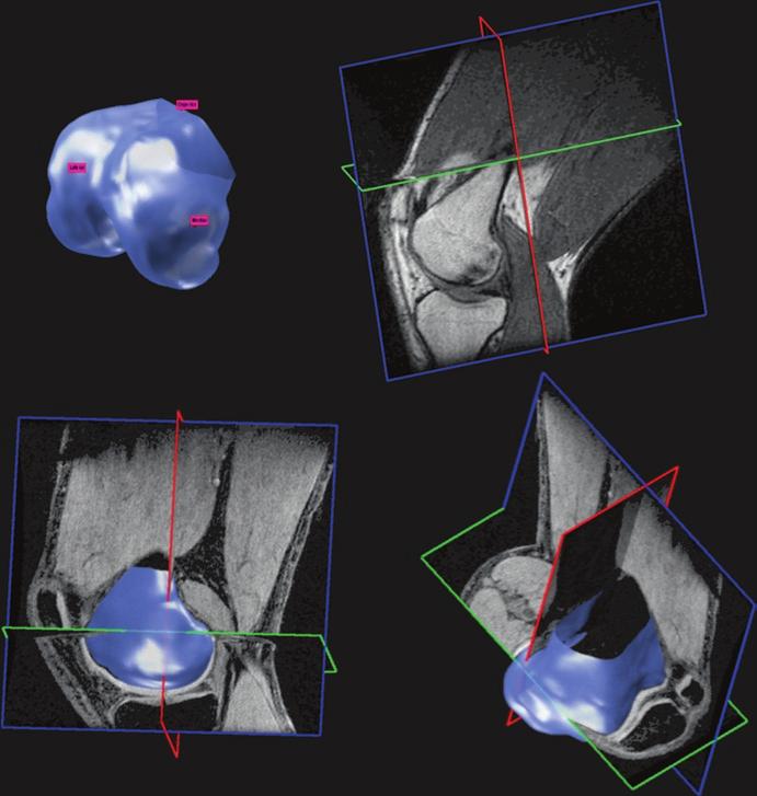 280 patella to our three-dimensional weight-bearing MR data sets (Fig..13).