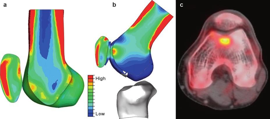 284 T.F. Besier et al. Fig..16 Bone density assignment from CT-based Hounsfield Units (a), and predicted bone-cartilage stress from finite element modeling (b) during a 60 static squat.