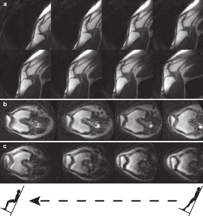 274 T.F. Besier et al. Fig..6 (a) Sample sagittal plane real-time MR images of patellofemoral joint during weight-bearing knee flexion.