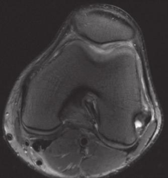 The superimposed CT image enables accurate localization of the PET hotspot, in this case within the apex of the left patella, which was consistent with the area of pain Fig.