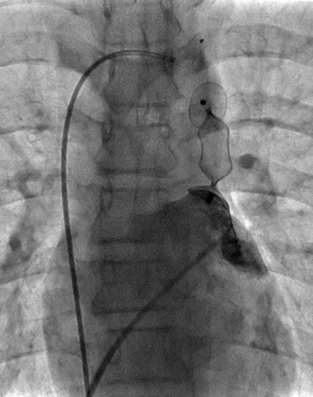 102 Zampi et al. Fig. 4. Left atrial angiogram performed through the transseptal sheath positioned in the left atrium.