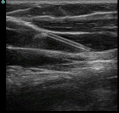 1300 Panebianco et al. ULTRASOUND-GUIDED PERIPHERAL IV PLACEMENT Figure 2. Still ultrasound image of a peripheral vein in longitudinal plane with an IV catheter within the lumen of the vessel.