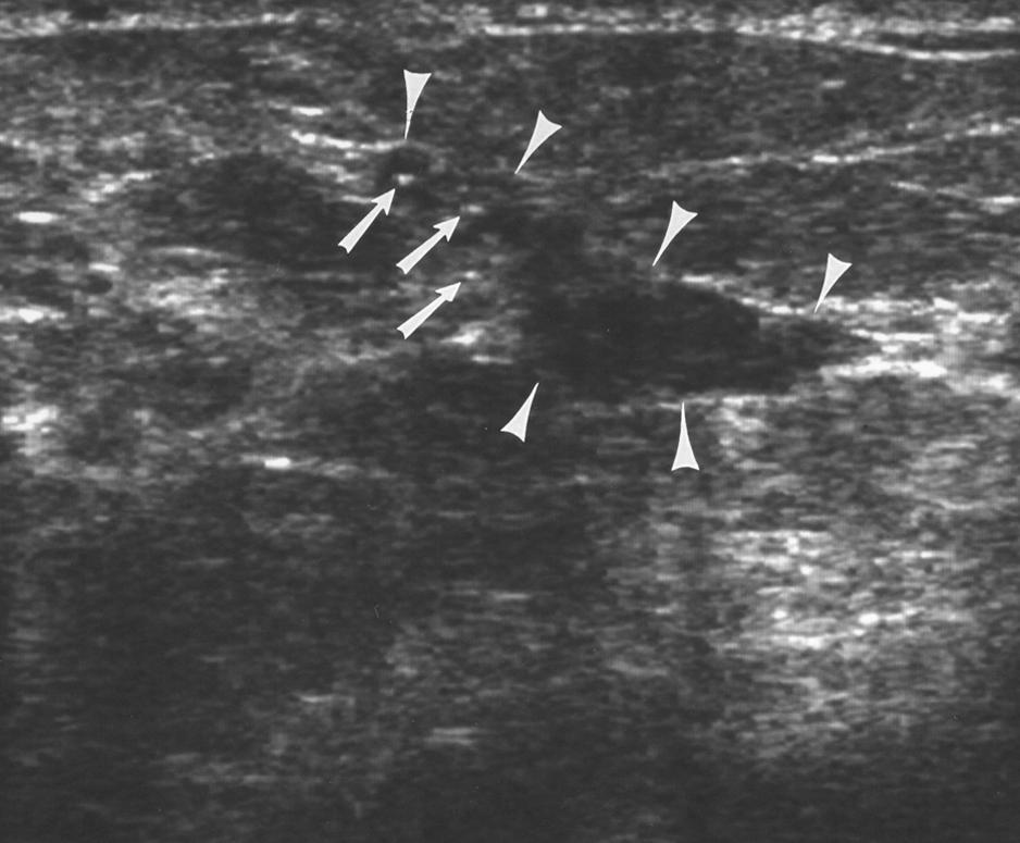 More core specimens were obtained during stereotactic biopsy of lesions in this group (range, 5 28; mean number of cores, 11) compared with the group seen on sonography and biopsied with sonographic