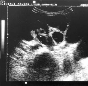 272 Vidmar D and Višnar Perovič A / Childhood intussusception After the diagnosis is made, the primary aim should be a non-operative reduction of the intussusception.