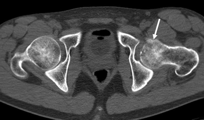 hemarthrosis (2 11). These findings highlight the possibility of a prior posterior hip dislocation.