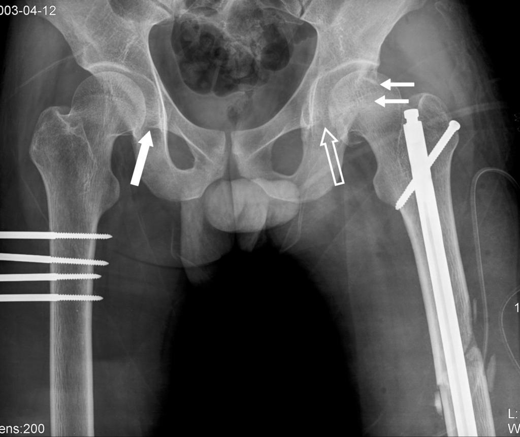 Such diagnostic criteria may be possible for posterior hip dislocations, which are analogous to the Bankart and Hill-Sachs lesions of anterior shoulder dislocations.