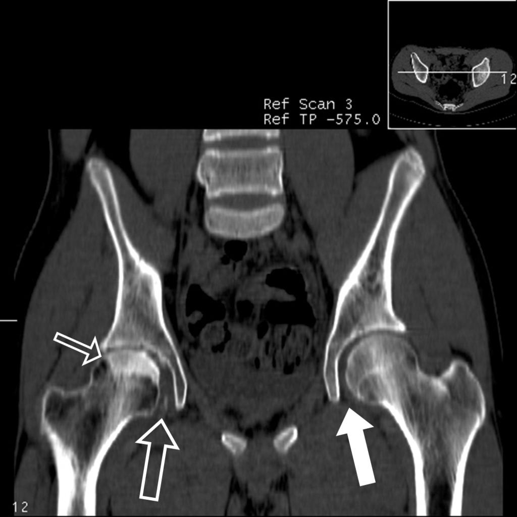 Sung Kyoung Moon, et al : CT Findings of Traumatic Posterior Hip Dislocation after Reduction A C Fig. 3. Hip images of a 15-year-old male with a posterior dislocation of the right hip (207 days ago).