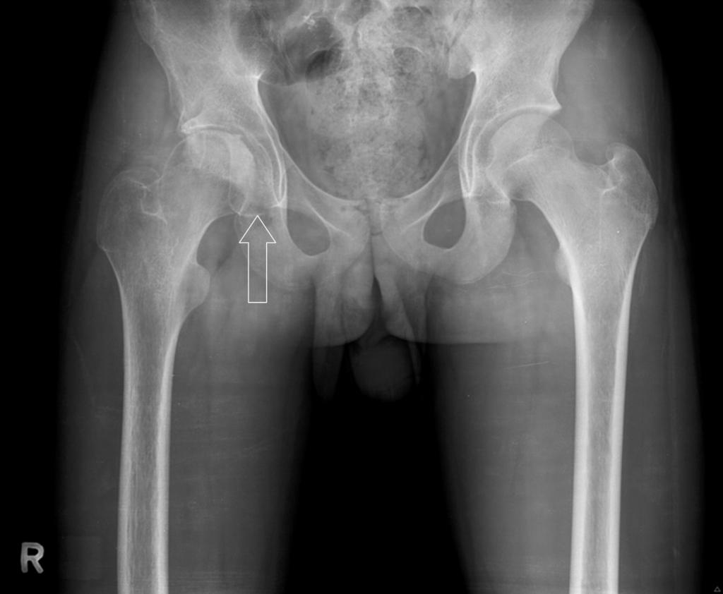 The medial aspect of the right hip is wider than that of the right side (empty arrow).