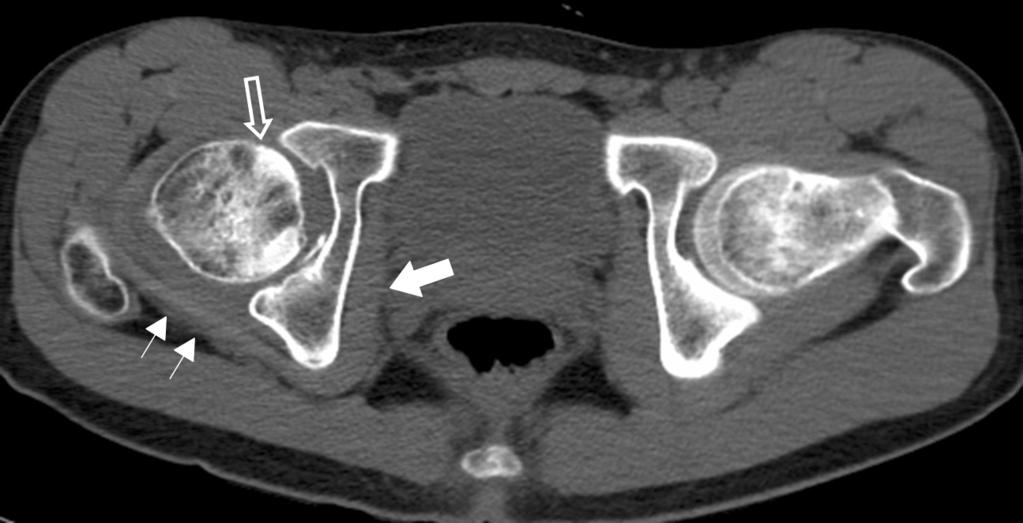 An axial CT scan shows a bone fragment in the joint space as well as the obliteration of the intra-articular fat.
