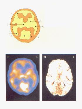 Transversal section of the human brain 1. Visual cortex 2. Occipital lobe 3.