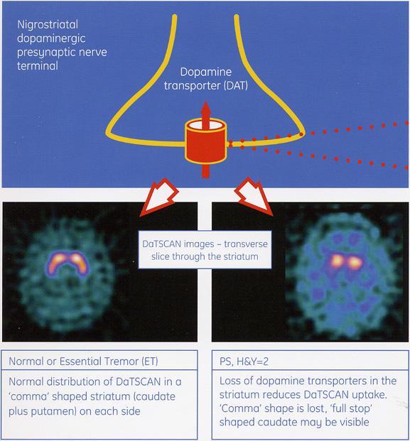 Theory of presynaptic dopamin receptor scintigraphy DATSCAN binds to the dopamine transporters (DAT), which are on the neurons in specific areas of the brain.