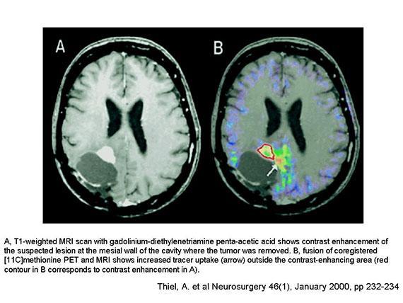 Methionin PET and MRI fused imaging: