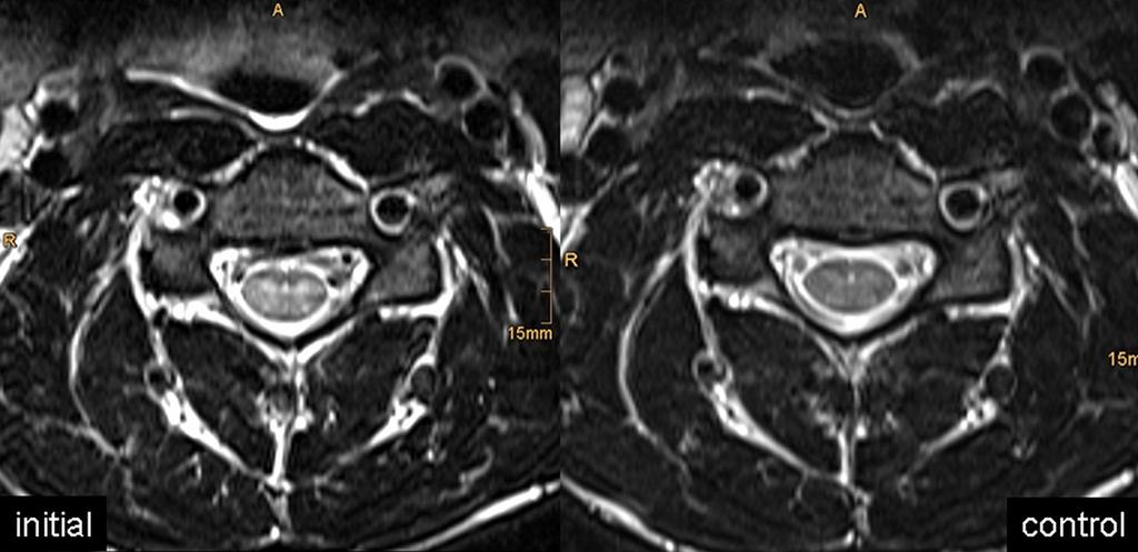 Fig. 2: 23-year-old patient with subacute combined degeneration (SCD) involving the cervical and thoracic