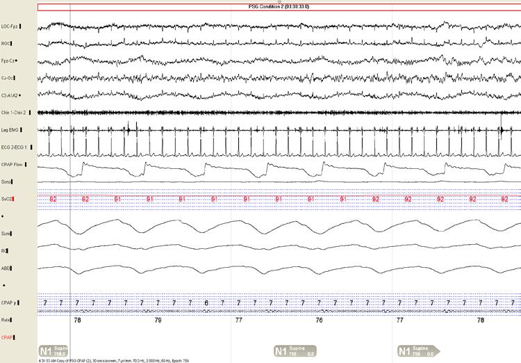 Question Choose all that apply: A. Patient has spikes in the EEG. B.