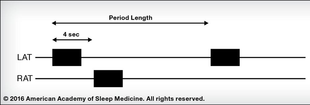 New for 2016 Question: Scoring Periodic Limb Movements in Sleep (PLMS) How
