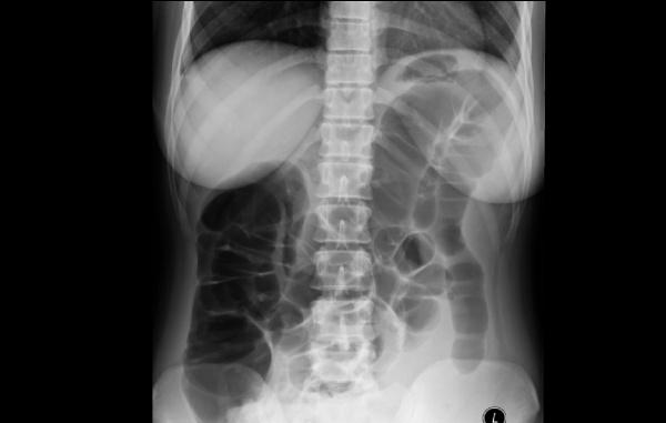 Yunen et al. 66 Figure 2: Abdominal X ray showed distended loops of bowel suggestive of ileus.