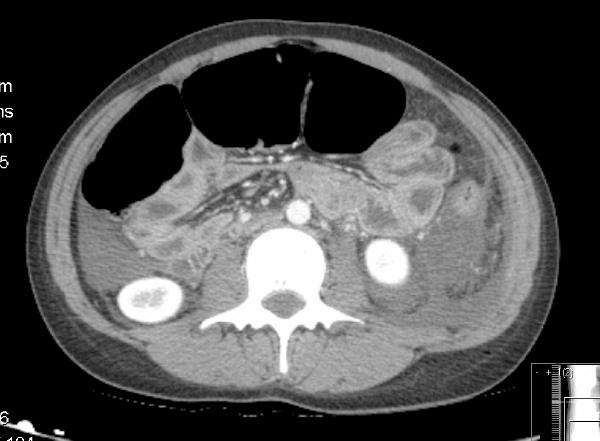 Figure 4: CT scan of abdomen and pelvis showed hepatic and common bile duct reduced to normal size gastrografin Isovue 300; power 123 ma, 120 kv.