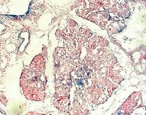 in the EYFP-negative (Shp2-positive) areas (right, arrowhead) of mammary gland tumors of PyMT;MMTV-Cre;Shp2 