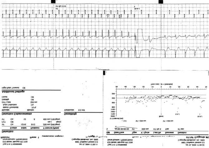 However, only nonsustained polymorphic VT was induced during programmed ventricular stimulation. The coved-type Brugada ECG in patient 1 disappeared several days later.