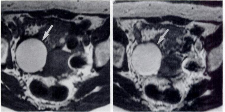 AJR:158, February 1992 MR OF BLOOD VS LIPID IN OVARIAN MASSES 323 Fig. 2.-Endometrioma of right ovary In 33-year-old woman.