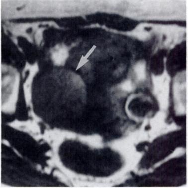 Only the hemorrhagic Ieiomyosarcoma and one endometrioma displayed a hypointense rim suggestive of hemosiderin.
