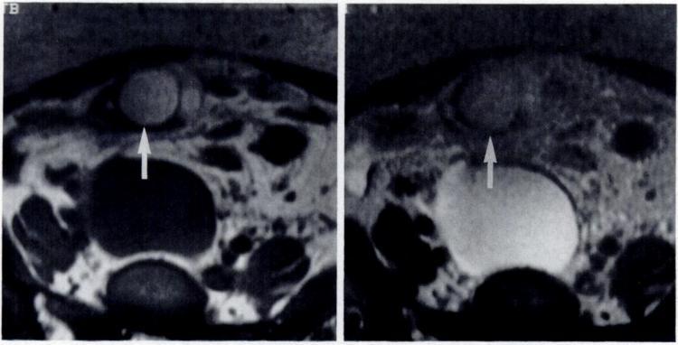 324 KIER ET AL. AJR:158, February 1992 and T2-weighted MR images, although this feature is absent in the majority of lesions [2].