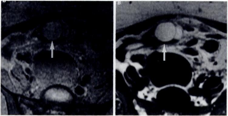 Ovarian cystic teratomas can be suggested if there is atypical chemical-shift artifact due to lipid within the tumor, although this feature may be difficult to detect at lower field strengths [3], at
