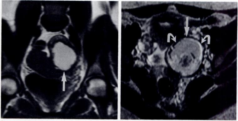 AJR:158, February 1992 MR OF BLOOD VS LIPID IN OVARIAN MASSES 325 Fig. 4.-Mature cystic teratoma in 28-year-old woman.