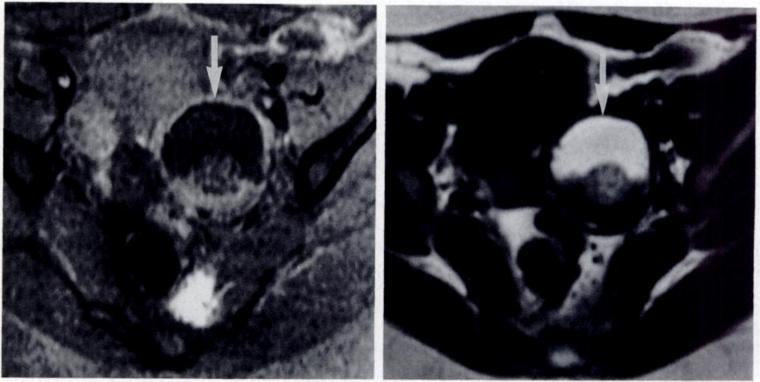 B, On axial 12-weighted (1900/80) MR Image, left ovarian mass (straight arrow) appears isointense compared with subcutaneous fat, although slightly heterogeneous.