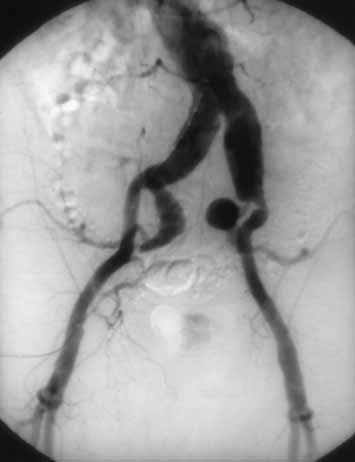 Nonetheless, the implications of hypogastric artery occlusion may not be quite so serious in the setting of endovascular repair of AAA.