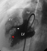 2. Patent Foramen Ovale (PFO) This is a small, naturally occurring opening in the wall separating the heart s upper chambers.