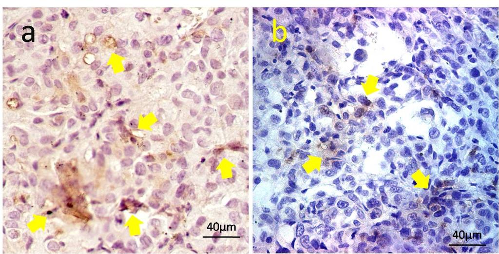 The engraftment of BMSCs in the tumour parenchyma