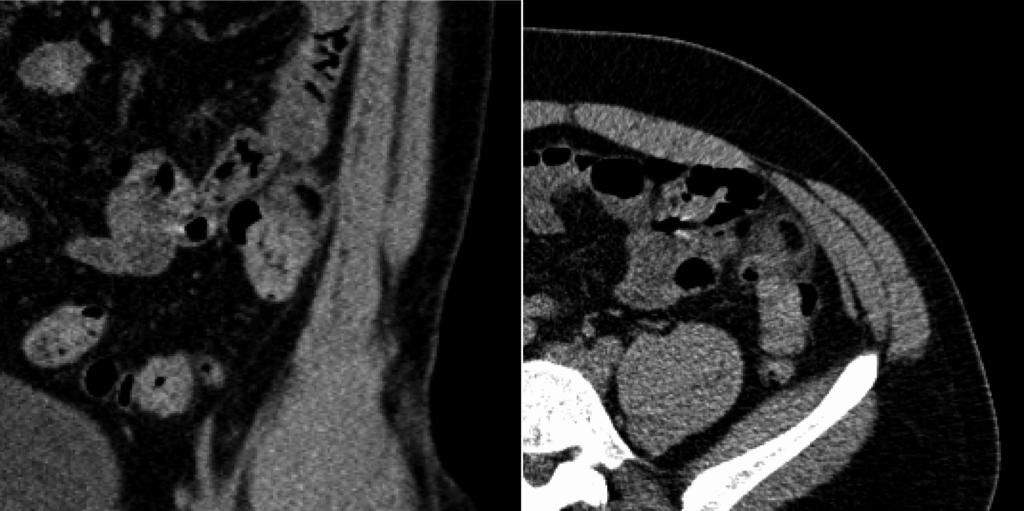 A B Figure 1 Longitudinal (A) and transverse (B) abdominal computed tomography with contrast enhancement, demonstrating primary epiploic appendagitis adjacent to the sigmoid colon.