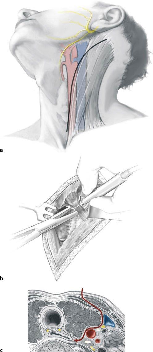 1 2 3 4 Section I General Principles No retractor should be placed against the recurrent laryngeal nerve in the tracheoesophageal groove during the entire cervical phase of the procedure For better