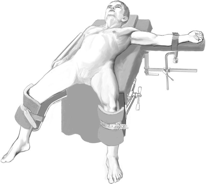 6 Section I General Principles 1 2 3 4 5 French Position The French position (. Fig. 2.2) is one possible patient position for a laparoscopic cholecystectomy (the American supine position with both arms tucked alongside the body being the other).