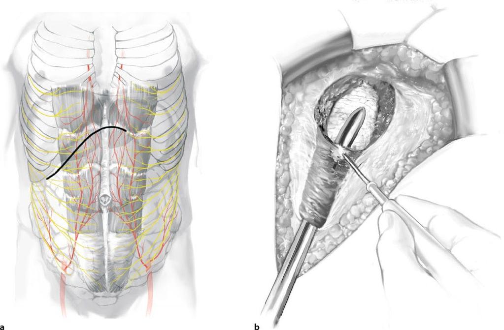 Chapter 2 Positioning and Accesses 11 2 Subcostal Incision (. Fig. 2.7a) The subcostal incision is usually made for cholecystectomy or common bile duct exploration (right subcostal incision) and for elective splenectomy (left subcostal incision) (.