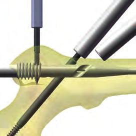 1 Assembly The Distal Attachment (GAP Dsa 150) is used for distal Cortical Screw preparation and insertion, in both the AP and lateral planes.