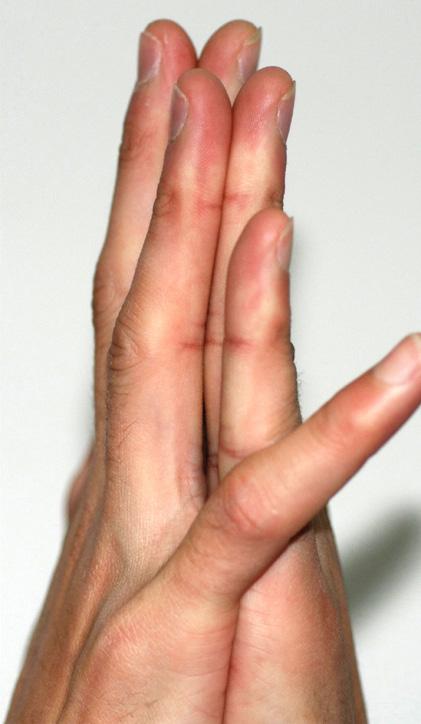 If the little finger could flex the PIP joint to touch the dorsal side of contralateral hand without flexion of the DIP joint of the tested hand and two ring