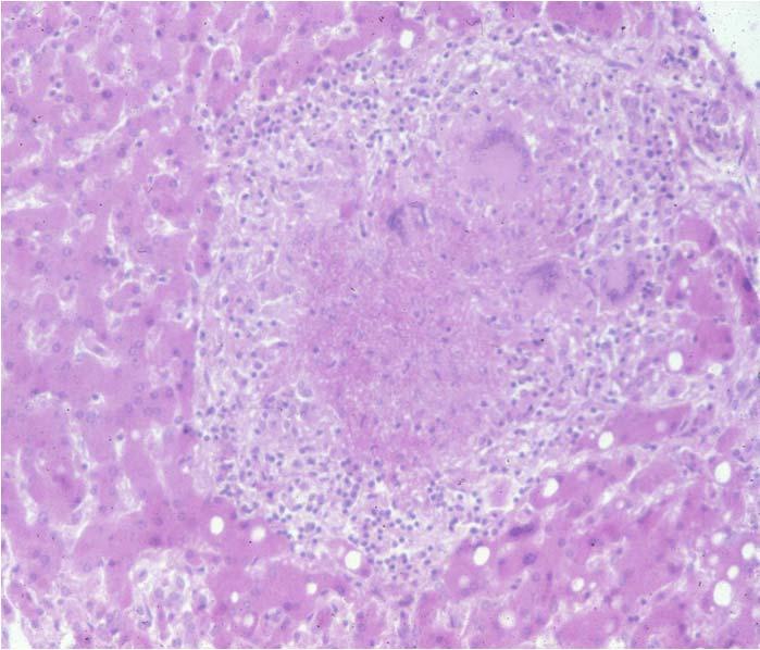 GRANULOMA FORMATION Poor Cell Mediated Immunity (CMI) Non