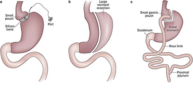 Bariatric Surgery Laparoscopic Adjustable Sleeve gastrectomy Roux-en-Y gastric band (Lap Band) gastric bypass Aron-Wisnewsky, 2012