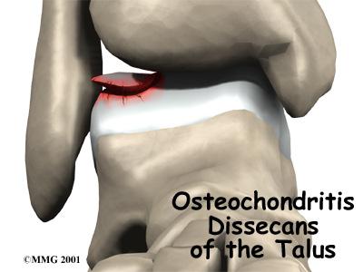 Introduction Osteochondritis dissecans (OCD) is a problem that causes pain and stiffness of the ankle joint. It can occur in all age groups.